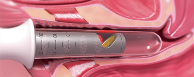 Illustrazione 3D del trattamento laser intravaginale Fotona® per atrofia e incontinenza