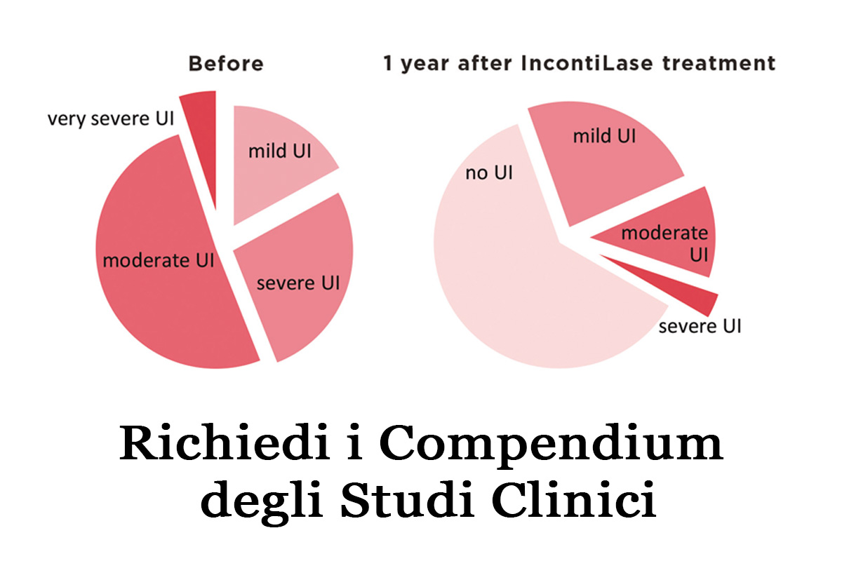Grafici a torta dei risultati clinici IncontiLase®: confronto prima del trattamento e dopo 1 anno — riduzione drastica dell'incontinenza severa